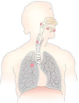 choroba nowotworowa przełyku i płuc